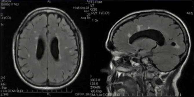 Фото бляшек при рассеянном склерозе, МРТ мозга