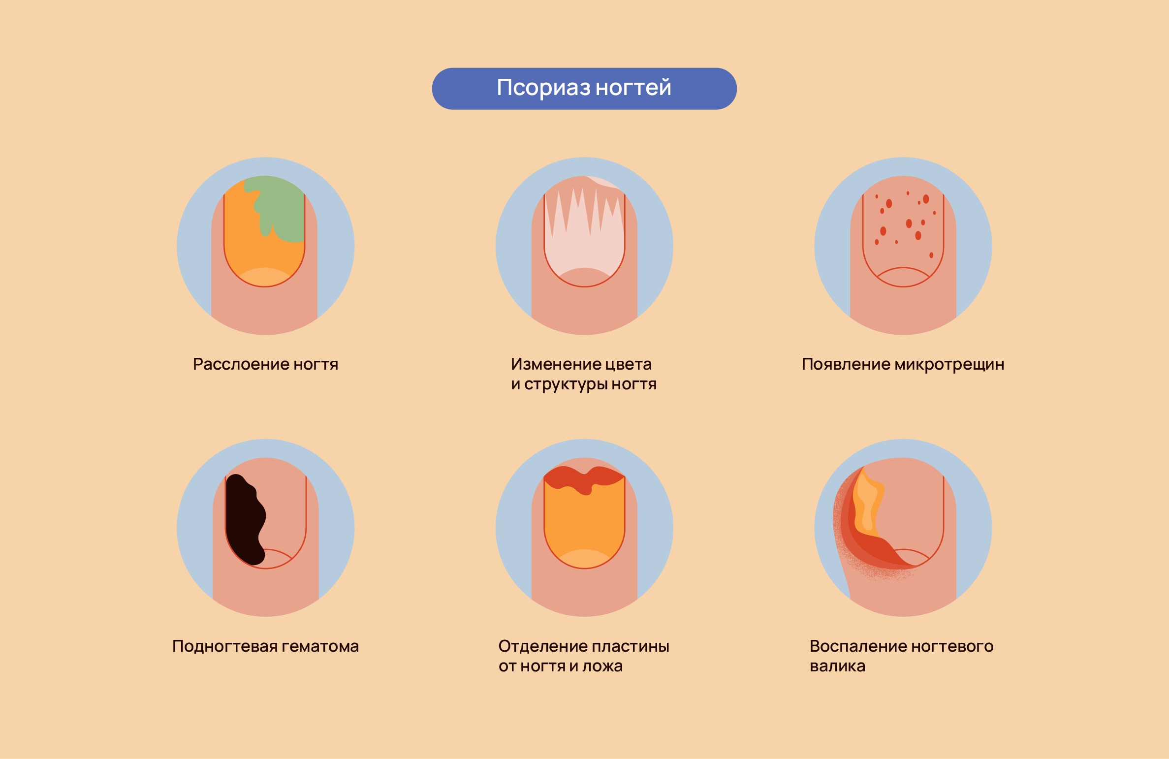 Лечение кожи и ногтей при псориатическом артрите