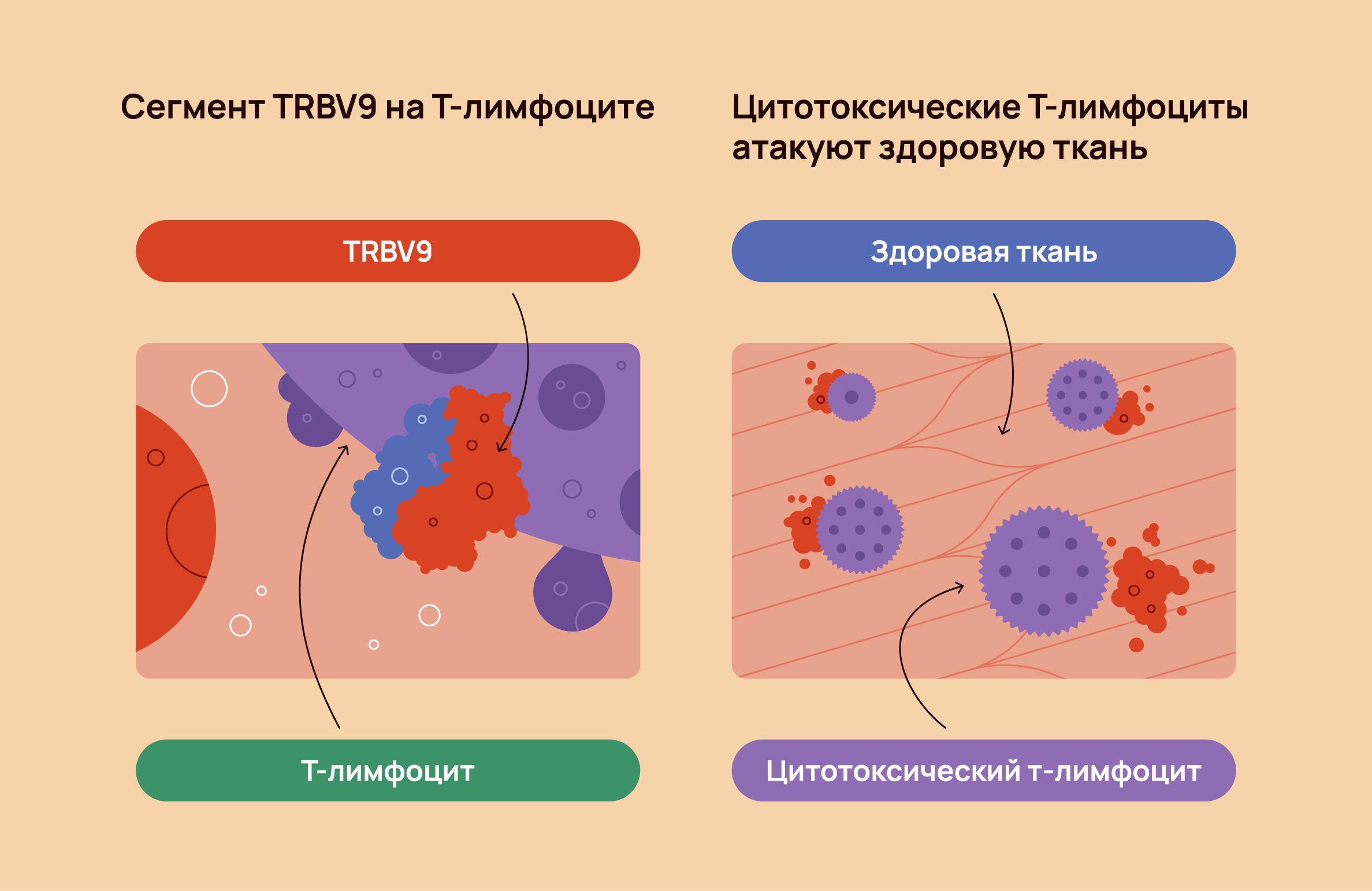 Болезнь Бехтерева (анкилозирующий спондилит)